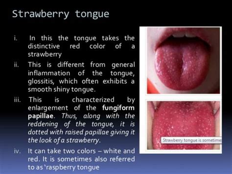 Strawberry tongue/raspberry tongue seen in SCARLET FEVER - MEDizzy