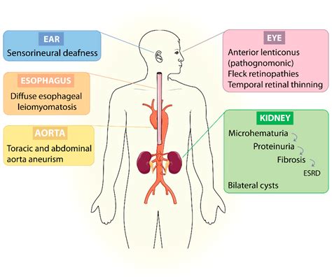 Renal Biopsy Alport Syndrome