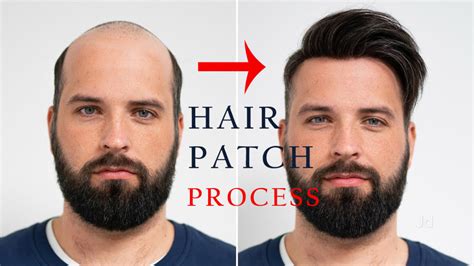 Hair Patch Fixing: Complete Procedure of Hair Patch Fixing & its methods