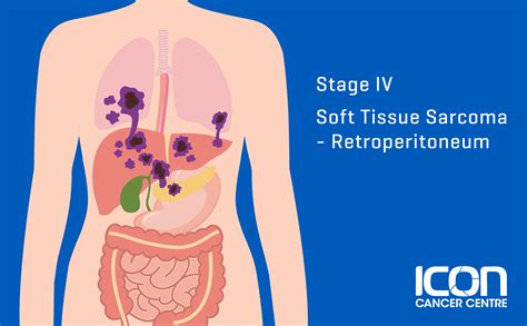 Soft Tissue Sarcoma Types, Signs, Symptoms & Stages