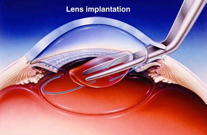 Best Lens Options For Cataract Surgery in 2024- EyeMantra