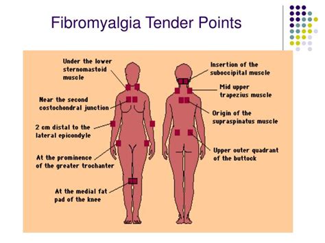 PPT - Soft Tissue Rheumatism PowerPoint Presentation - ID:4008253