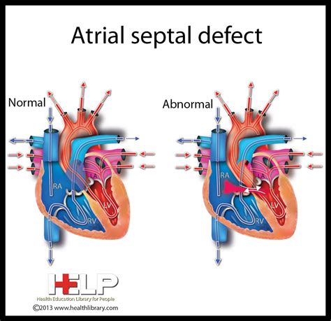 Atrial Septal Defect... technical term for Layci's condition, Neonatal ...