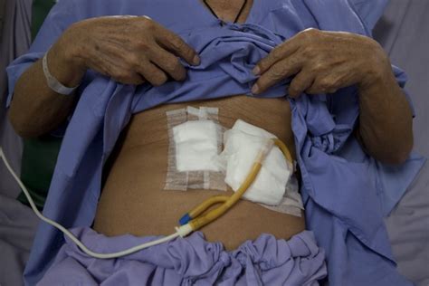 PEG tube insertion - The Surgery - Dr Karanu - Ndagitari