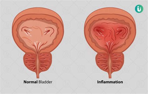 ब्लैडर इंफेक्शन के लक्षण, कारण, इलाज, दवा, उपचार और परहेज - Bladder ...