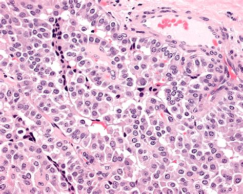 Pathology Outlines - Medullary