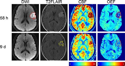 Ischemic Vs Hemorrhagic Stroke Mri