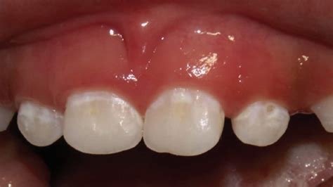 Pathways for the Management of Early Childhood Caries