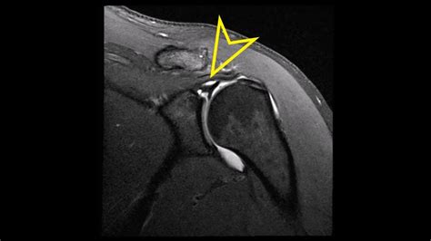 Shoulder MRI: Labral SLAP (Superior Labrum Anterior Posterior) Tear ...