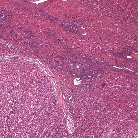 Histology of HCC with hemosiderosis, Hematoxylin and eosin staining ...