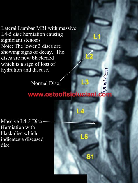 mri bone spur - Google Search | Mri, Mri scan, Magnetic resonance imaging