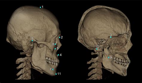 3D cephalometric landmarks used in this study were marked on the skull,... | Download Scientific ...