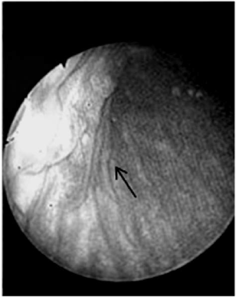 Another view during cystoscopy. | Download Scientific Diagram