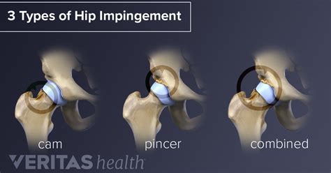 Hip Impingement Definition | Defined by Arthritis-Health