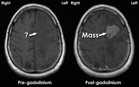 Gadolinium Mri