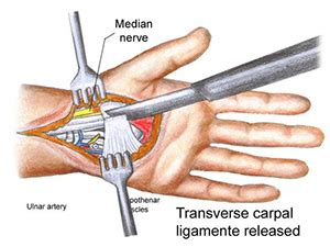 Recovery Times After Carpal Tunnel Surgery