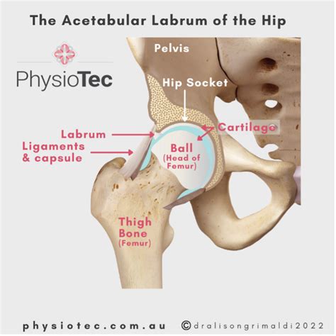 Hip Labral Tear: Causes, Symptoms, and Effective Management