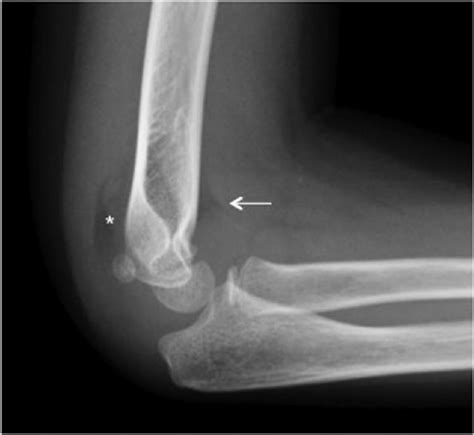 Posterior fat-pad sign (asterisk) is specific to an occult elbow ...