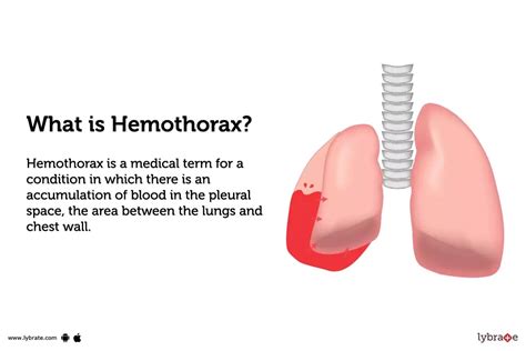 Hemothorax: Causes, Symptoms, Treatment and Cost