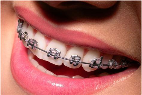 Enjoy Wearing Metal Braces Singapore