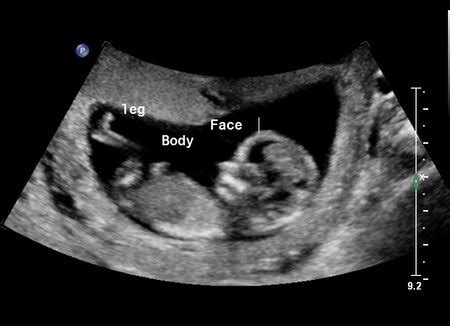 How To Tell Gender On Ultrasound At 12 Weeks