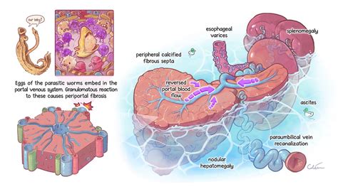 Schistosomiasis — artibiotics