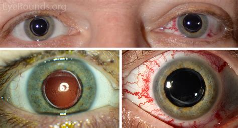 Atlas Entry - Exophthalmos secondary to a carotid cavernous fistula