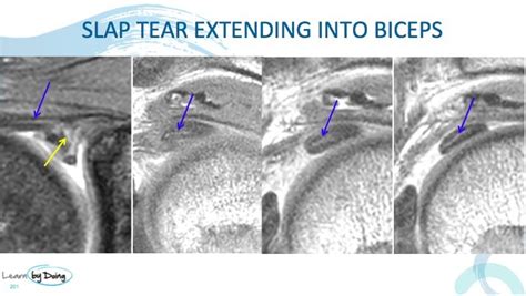 SLAP 4 Tears The best way to find biceps extension of the tear on MRI - Radedasia