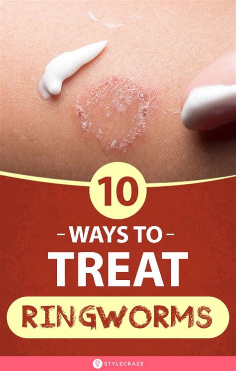 Home Remedies For Ringworms – 10 Ways To Treat The Symptoms | Home remedies for ringworm ...