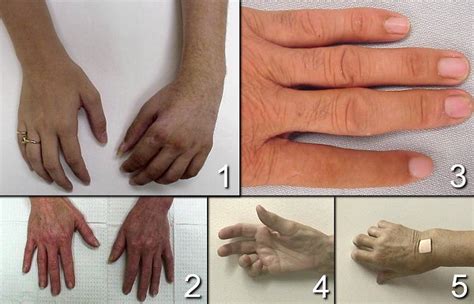 Reflex Sympathetic Dystrophy; Shoulder-Hand Syndrome; Sudek Atrophy; Algodystrophy; Complex ...