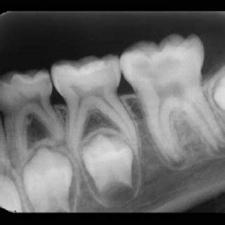 (PDF) A clinical and microbiological comparative study of deep carious lesion treatment in ...