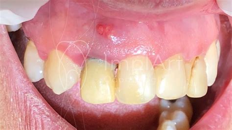 Fistula Gums