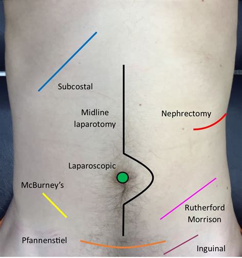 Abdominal exam - OSCE