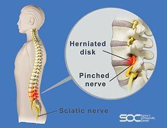 Pinched Nerve Treatment in South Florida | Spine & Orthopedic Center