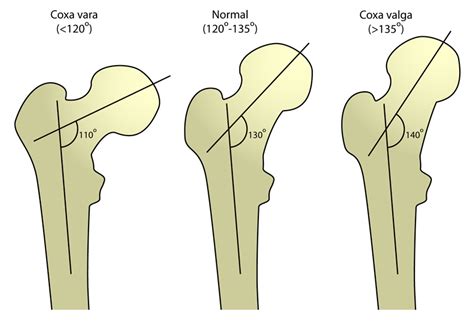 Tu anatomía condiciona tu apertura de caderas – Ariel de Gatica