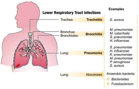 Respiratory Tract Infection Symptoms and Treatment