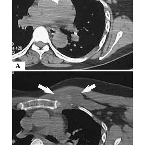 A-B (A) An axial CT scan of the chest (soft tissue windows) shows a ...