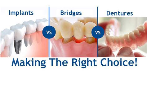 What Are The Alternatives To Dental Bridges? ~ Dr. Bharat Katarmal ...