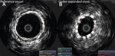 Optimizing Technique for Success: A Guide for the Use of IVUS in ...