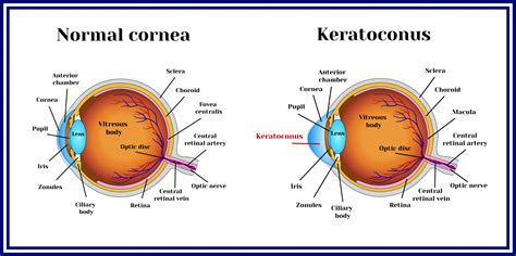 Keratoconus Diagnosis & Treatment | Twenty Twenty Eyecare