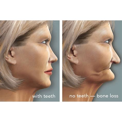 Tooth Loss Leads to Bone Loss: Causes, Costs & Solutions