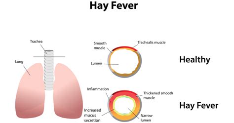 Understanding Hay Fever: Causes, Symptoms, And Treatment Options - Ask ...