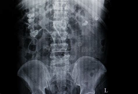 IVU xray for kidney stones stock photo. Image of expertise - 4862334