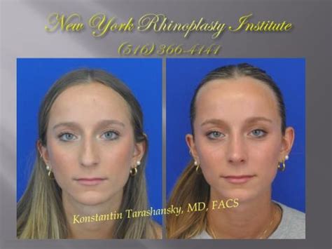 Patient Gallery | New York Rhinoplasty