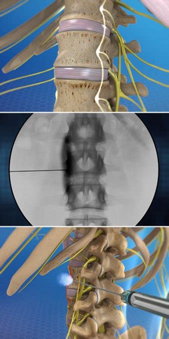 Lumbar Sympathetic Block – Pain Specialists of Southern Oregon