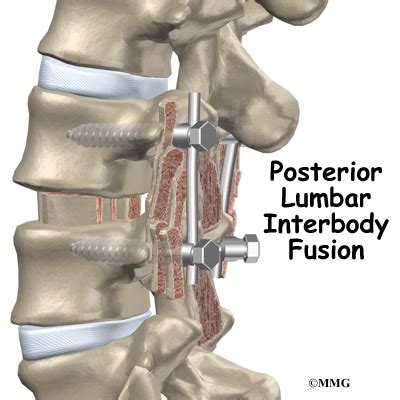 Posterior Lumbar Interbody Fusion - Orthopedic Surgery, Algonquin, IL, Barrington, IL, Elgin, IL ...