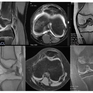 MRI of the knee. (a) Normal ACL images. (b) ACL tear. | Download ...