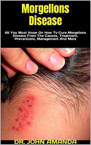 Morgellons Disease : All You Must Know On How To Cure Morgellons ...