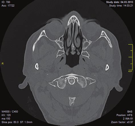 Axial CT scan of the patient. | Download Scientific Diagram