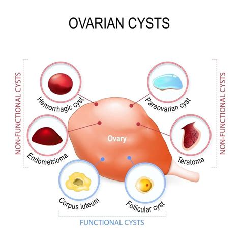 Should You Be Worried About an Ovarian Cyst? - Sunshine State Women's ...